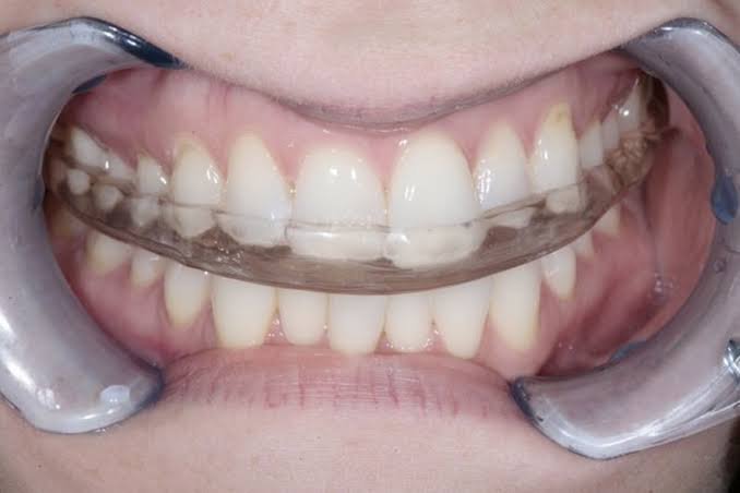 A custom Un-clench night guard fitted, showing the real clinical fit against the teeth